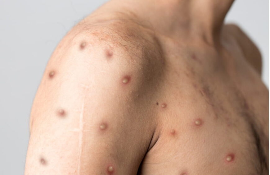 monkeypox rash on chest